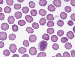 Echinocyte